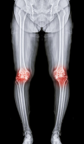 膝関節のレントゲンと痛み