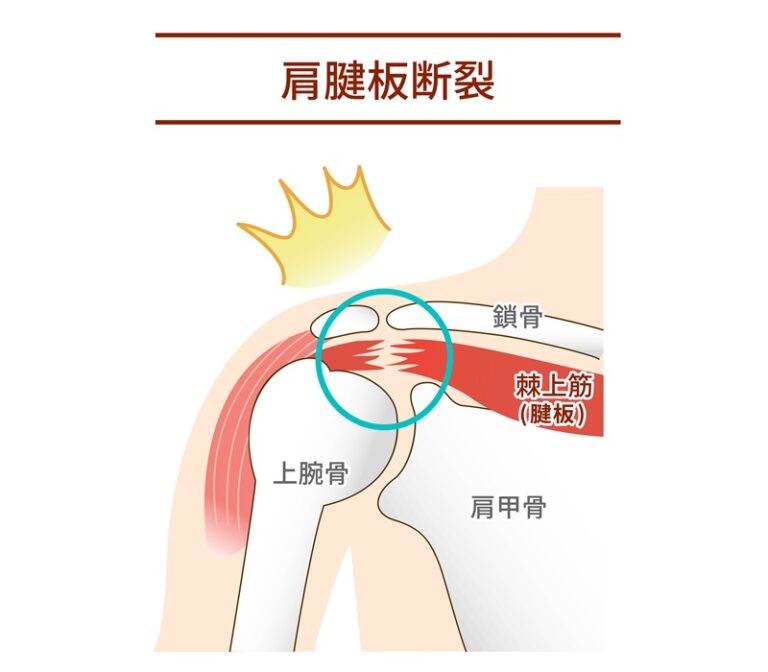 野球肩の肩腱板損傷